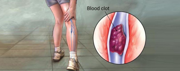 DEEP VEIN THROMBOSIS (PHLEBOTHROMBOSIS)